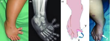 Image result for Hallux Varus