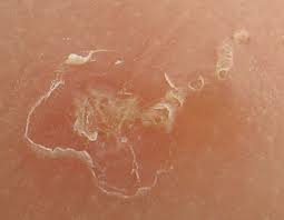 Apa itu kudis buta (scabies) ? Kudis Buta Scabies Punca Simptom Dan Rawatan The Diagnosa