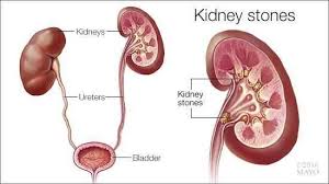 Kidney Stone Kidney Stone Is A Crystalline And Hard Mineral Material Which Is Formed Within Th Kidney Stones What Causes Kidney Stones Chronic Kidney Disease