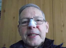 Bike helmet use for blood thinner safety concerns