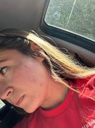 What are some affordable skin care recommendations for white bumps