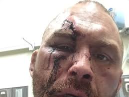 Bare knuckle fighting championship (bkfc) — американский промоушен бокса. Pic Chris Leben S Face Needed Some Serious Help After Bkfc 6 Loss Mmamania Com