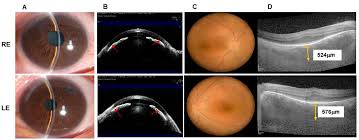 Effect of Combined Surgery in Patients with Complex Nanophthalmos