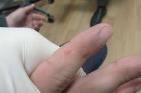 After he fingered you, did you orgasm? Red Bumps On The Fingers Clinical Advisor
