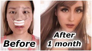 Rhinoplasty modifies the functional properties and aesthetic appearance of the nose through operative manipulation of the skin, underlying cartilage, bone, and lining. Rhinoplasty 1 Month Update Before After Id Hospital Surgery Part 2 Youtube