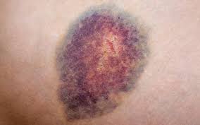 Einen bluterguss mit hausmitteln zu behandeln, ist nicht schwierig, aber durchaus wirkungsvoll. Pferdekuss Behandlung Hilfe Bei Prellungen Praktischarzt