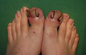 Emuaid.com has been visited by 100k+ users in the past month Infected Foot Symptoms Types Risk Factors And Treatments