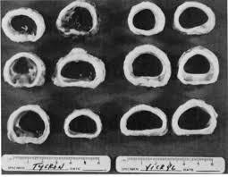 A two staged modified mladick approach was used to reimplant the amputated ear … A Comparison Of Synthetic Absorbable Suture With Synthetic Nonabsorbable Suture For Construction Of Tracheal Anastomoses Chest