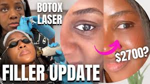 Is permanent hair removal really possible? Getting Laser Hair Removal On Dark Skin Cutera 1064 Laser Youtube