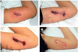 Image result for wolf spider bite skin