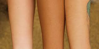 Birth Control And Acne How Birth Control Affects Skin Hair