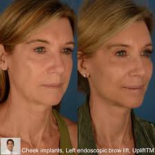 Filler fatigue treated with permanent cheek implants. This beautiful 62  year old woman had botox and filler injections for the prior 25 years. She  wanted more long term results. She is shown