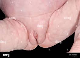 Image result for Inguinal hernia child