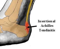 I am super upset because i have a series of races. Racing Stripes Insertional Achilles Tendonitis Recovery