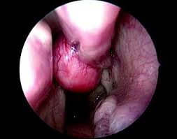 Like all diseases, it is better if it is treated early in life. Nasal Polyposis In Children A Differential Diagnosis And Algorithm Springerlink