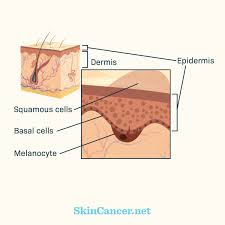 If you've received a diagnosis, here are some things you need to know about the condition. What Is Metastatic Melanoma And How Is It Treated