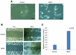 Look for changes the biggest clue that a spot on the skin might be melanoma is if it's changing. Mcp1 Induced Epithelial Mesenchymal Transition In Head And Neck Cancer By Akt Activation Anticancer Research