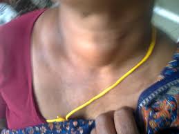 View the most common signs and symptoms of thyroid cancer that you need to know about. Thyroid Adenoma Wikipedia