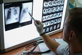 Studies profile lung changes in asymptomatic COVID-19, viral loads ...