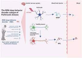 The relationship between serum neurofilament light chain and glial  fibrillary acidic protein with the REM sleep behavior disorder subtype of  Parkinson's disease - Teng - 2023 - Journal of Neurochemistry - Wiley  Online Library
