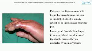 Image result for phlegmon of hand)