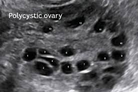 It affects the ovaries and involves the female hormones which regulate the although ovarian cysts are usually present, hence the term polycystic ovary syndrome, many women with pcos may not have any ovarian cysts. Polycystic Ovary Syndrome Women Tell Their Stories Of The Debilitating Condition Abc News Australian Broadcasting Corporation