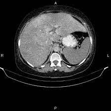 Budd Chiari Syndrome Radiology Case Radiopaedia Org
