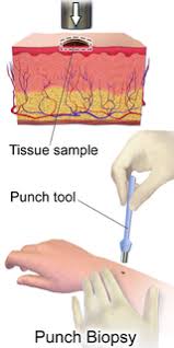 The wound will then require suturing (stitches). Skin Biopsy Wikipedia