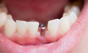 She needs to chew like a cud. How Strong Are Dental Implants Compared To Real Teeth