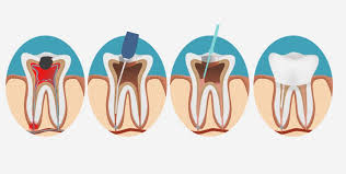 1 was ist eine wurzelkanalbehandlung? Wurzelbehandlung Dauer Ablauf Schmerzen Zahnarzt Ingolstadt