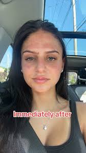 Microneedling at Home Review After First Time