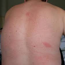 Image result for Erysipeloid