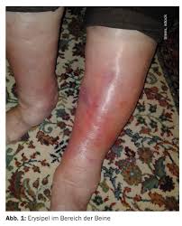 Image result for erysipel photos)