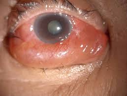 Image result for Proptosis