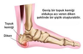 Topuk Dikeni Rahatsizligina Karsi Denenmis Dogal Yontem Topuk Dikeni Saglik Urunleri Saglik Ipuclari