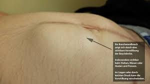 Besonderheiten und symptome, die auf komplikationen hindeuten könnten, sollten den patienten veranlassen leistenbruch. Bauchwandbruch Operation Von Nabel Oberbauch Narbenbruch