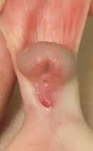 Hipospadias, bazı cinsiyet gelişim anomalilerine de eşlik edebilir. Hipospadias Cirugia Pediatrica Fundacio Hospital De Nens De Barcelona