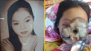 Bikin Merinding! Calon Artis Ini Gagal Orbit dan Meninggal Karena Derita  Infeksi Langka