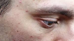 Cinco Coisas Que Nao Se Deve Dizer Para Quem Tem Acne Bbc News Brasil