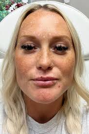 🔗: bit.ly/4moCIBx A Georgia mom was left paralyzed, thinking she was  “slowly dying” after Botox and Dysport injections gave her botulism, per a  report in Daily Mail. 📷️: Amanda Wolaver