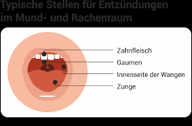 Entzundungen Im Mund Und Rachenraum Behandeln Vorbeugen