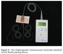Scielo Brasil Diaphragmatic Pacing Stimulation In Spinal Cord Injury Anesthetic And Perioperative Management Diaphragmatic Pacing Stimulation In Spinal Cord Injury Anesthetic And Perioperative Management