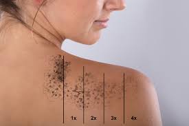 Despite the fact, laser tattoo removing is the most common way for removing a tattoo, it isn't the best, simply due to the fact, there are a lot of facts you each treatment can be done after 4 weeks, in order to the skin to heal and to recover. How Long Does Laser Tattoo Removal Take Rejuvene Md