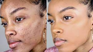 However, if you decide to cover the spots instead, the process requires some basic. How To Cover Acne Dark Spots Without A Lot Of Makeup Slim Reshae Youtube