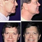 RONALD E IVERSON, MD, FACS