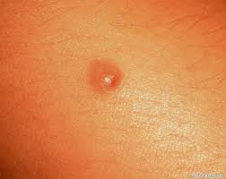 Image result for Spitz Nevus
