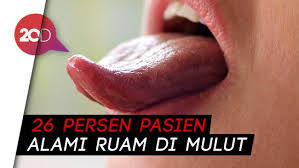 Satu Lagi Gejala Baru Corona Lidah Ada Benjolan