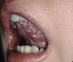 Image result for Candidiasis