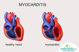 Lecture in internal medicine for v course myocarditis is an inflammatory disease of the myocardium with a wide range of clinical presentations. Myocarditis Causes Symptoms And Treatment
