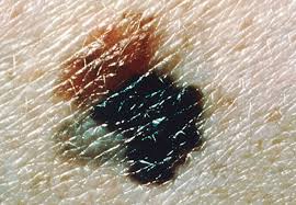 What does skin melanoma look like? Gene Profile Test Holds Predictive Potential For Early Stage Melanoma Patients Consult Qd